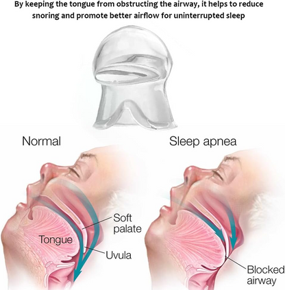 SleepEase™ Mouthguard - Fix snoring & sleep apnea